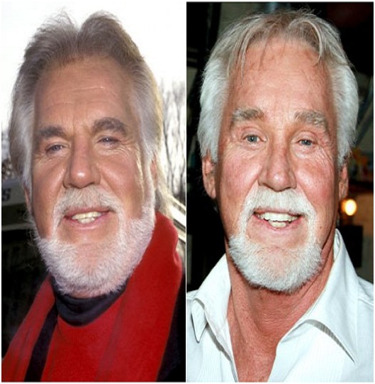 Kenny Rogers (Before & After) Top 15 Celebs with Plastic